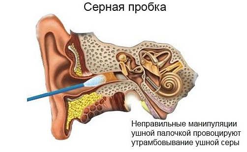 Чому утворюються сірчані пробки у вухах?